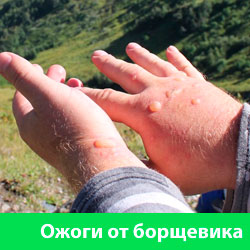 Ожоги от борщевика